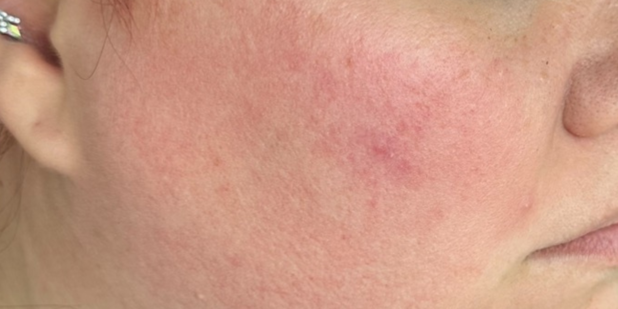 Before and after skin transformation – improved calm & even tone